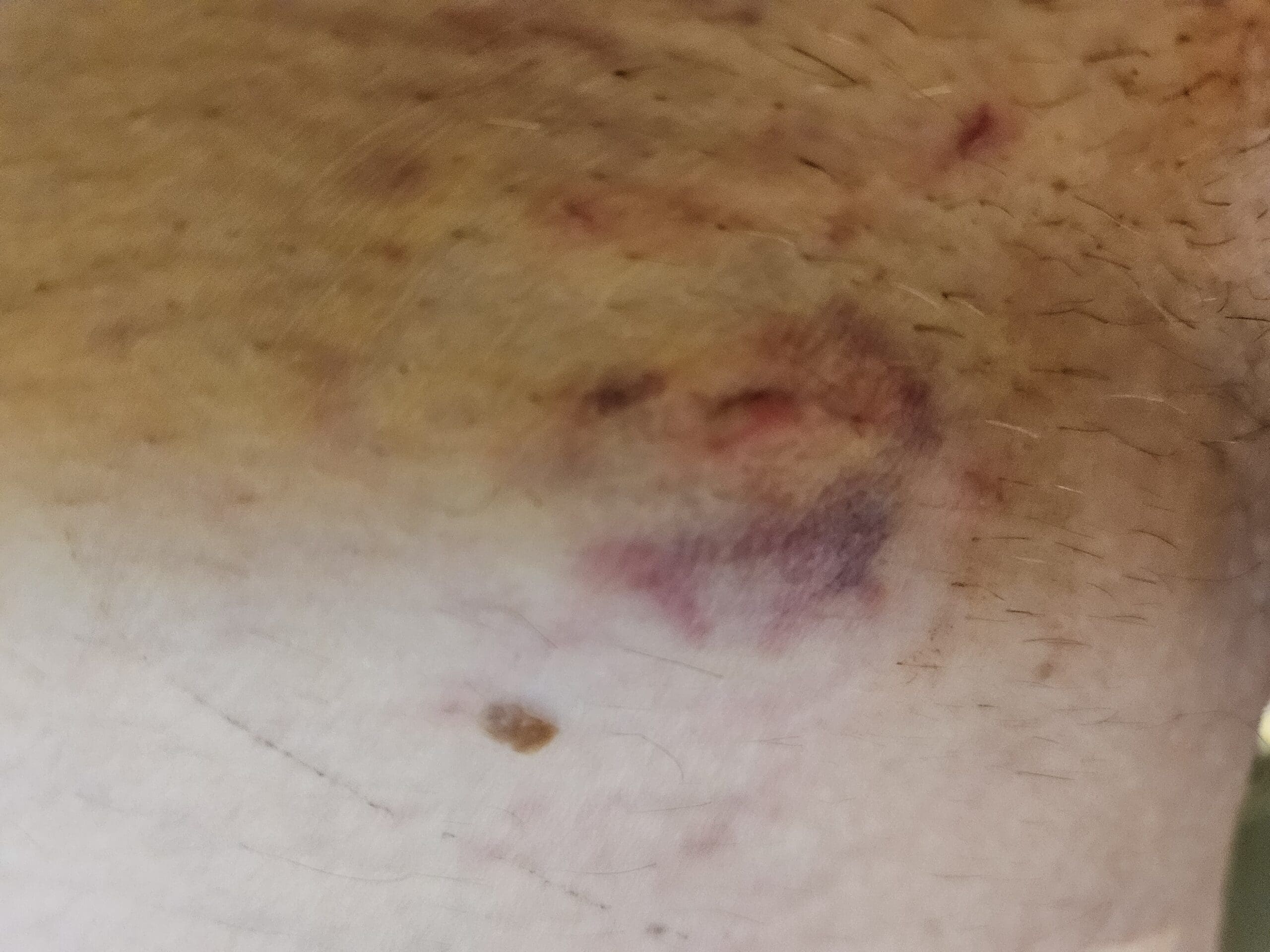 Ikke meget at se 2 dage efter – imponerende